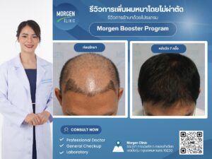 มอเก้นคลินิก ฉลองครบรอบ 5 ปี เปิดตัวโปรแกรมปลูกผมโดยไม่ต้องผ่าตัด พร้อมมอบส่วนลดพิเศษถึง 30%