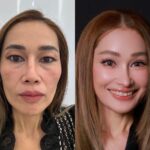 “คุณเปิ้ล” แม่ลูกสองวัย 48 ปี ผู้คว้าชัยชนะ Surgery Wars EP.3 กับการ Make Over ใบหน้า ผสาน 3 เทคนิคศัลยกรรมเฉพาะทางจาก IDL Hospital